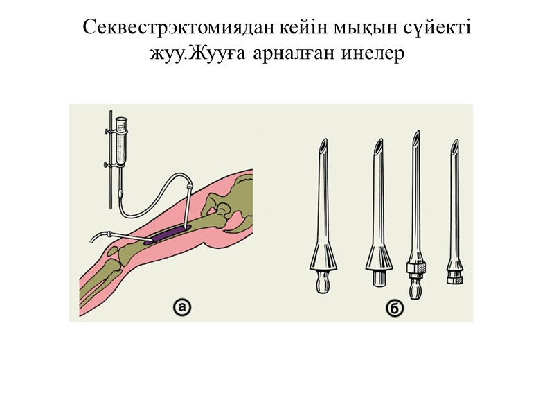 Секвестрэктомиядан кейін мықын сүйекті жуу.Жууға арналған инелер